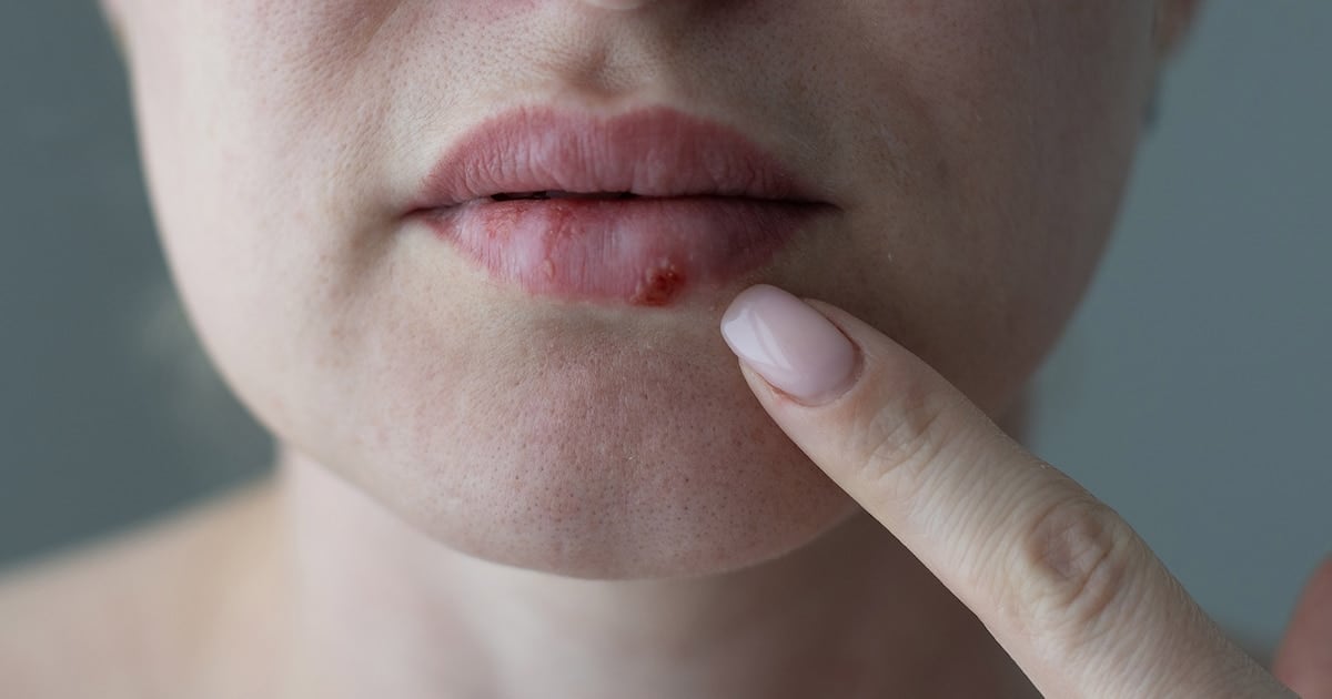 Histórico: la FDA aprobó el primer antiviral oral nuevo contra el herpes resistente en casi 30 años