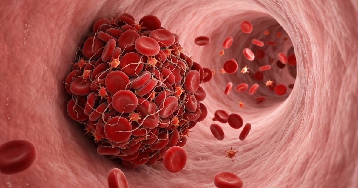 Coágulos en las venas: las cuatro señales que el cuerpo envía antes de una trombosis